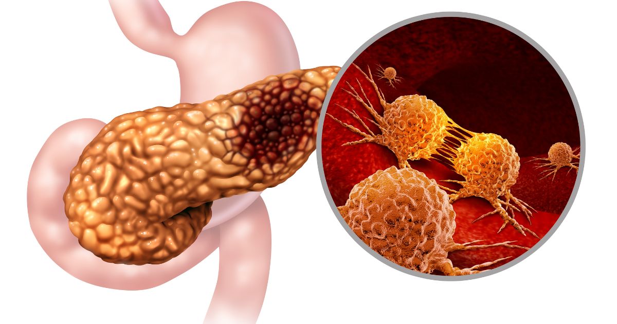 Pancreatitis risk — what you need to know